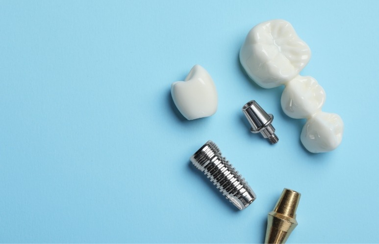 Des restaurations sur implants pour différentes situations
