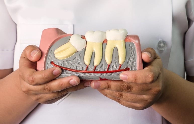 Extraction des dents de sagesse 