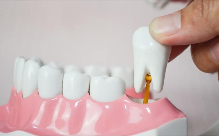 Extractions dentaires : 
pas que pour les dents de sagesse