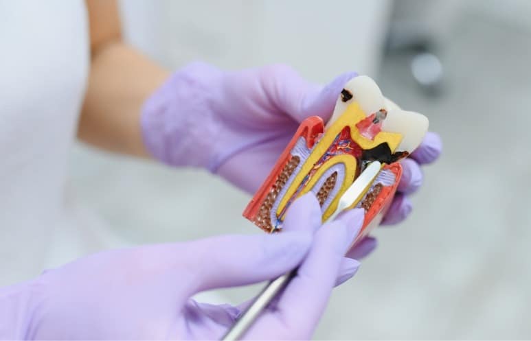 Comment la carie se forme-t-elle ?