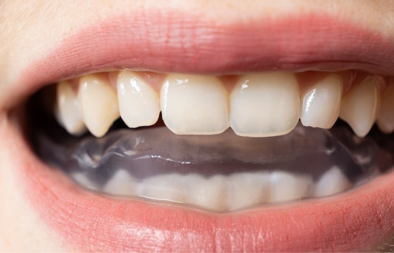 Pratique sportive et risques pour la bouche 