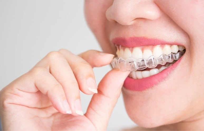 Qu’est-ce que le traitement Invisalign ? 